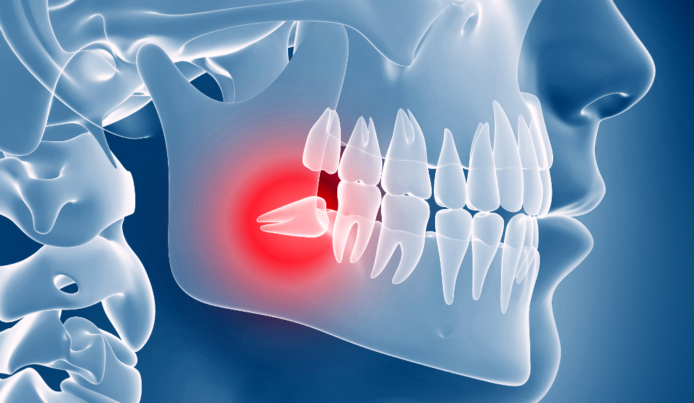chirurgia orale dente del giudizio