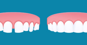 diastema
