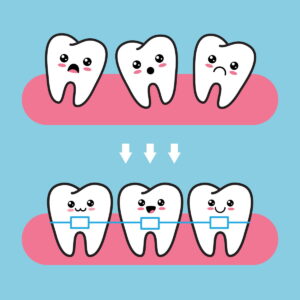 Apparecchi denti bambino