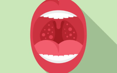 Bollicine sulla lingua / bolle in bocca