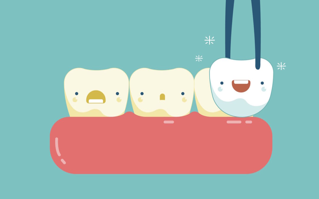 Faccette dentali: cosa sono e a cosa servono